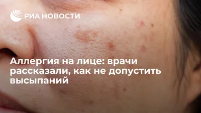 Аллергия на воду: бывает ли, как выглядит, что делать | РБК Life