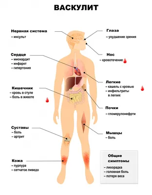 Пурпуры - диагностика и лечение в частной клинике в Киеве - Profderm