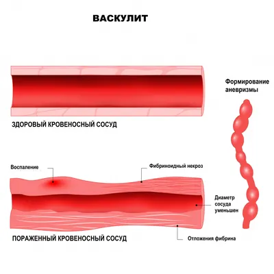 Болеутоляющие средства Dr. Reddy's Кеторол Экспресс - «Хорошо обезболивает,  но есть неприятные побочки» | отзывы