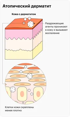 Аллергический дерматит в Харькове – Центр дерматологии и лечебной  косметологии Sana.