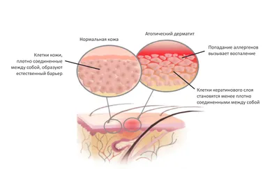 Атопический дерматит