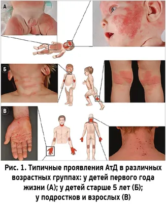 Атопический дерматит у ребенка: полное описание, симптомы и причины