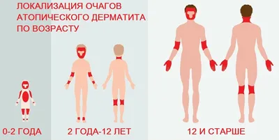 Атопический дерматит у взрослых и детей: лечение, симптомы, причины  дерматита | Клиника МедПросвет