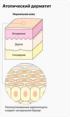 Лечение атопического дерматита (экземы), Киев