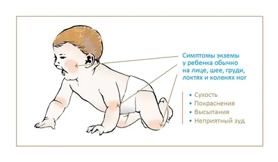 Атопический дерматит. \"Лига Докторов\" помогите советом | Пикабу