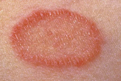 Розовый лишай (лишай Жибера) - инфекционно-аллергическая эритема.  Заболевание не заразное. Провоцируется розовый лишай стрессами, простудой…  | Instagram