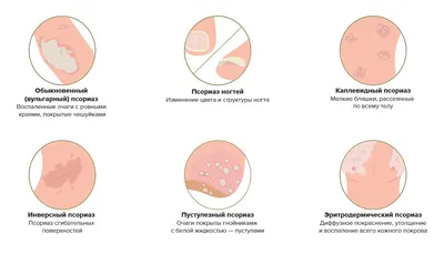 Псориаз — причины возникновения, методы лечения и профилактики – Семейная  клиника «Доктор АННА»