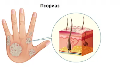 Лечение ПСОРИАЗА