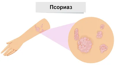 Я говорила всем, что это аллергия»: личная история о жизни с псориазом