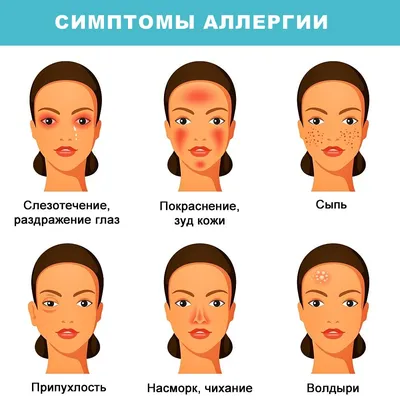 Первые признаки аллергии: симптомы, диагностика, лечение первых признаков  аллергии - Аллергология и иммунология – Государственная больница НКЦ №2  (ЦКБ РАН)