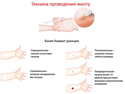 Диаскитэст или ваш ребёнок тубинфицирован? | Пикабу