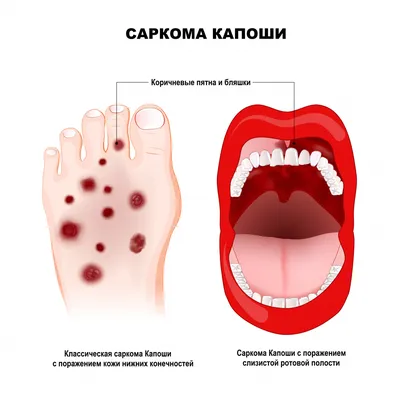 Ветрянка у детей: симптомы, лечение и информация для родителей