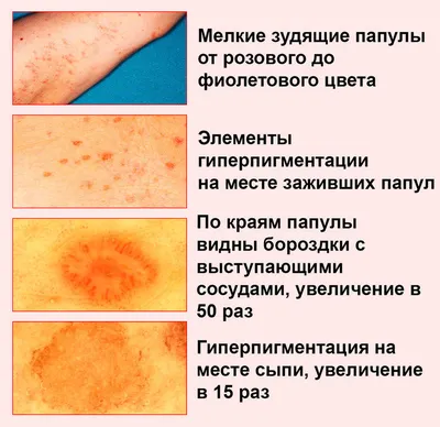 Саркома Капоши - симптомы острой и хронической форм, стадии и признаки у  мужчин и женщин, причины появления, диагностика и лечение заболевания