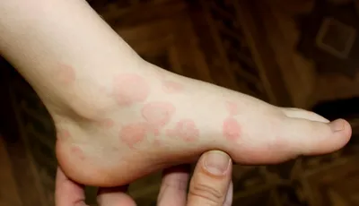 Инфекционная эритема (Erythema infectiosum)