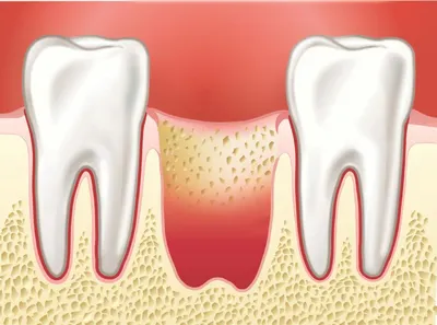Альвеолит - воспаление десны после удаления зуба
