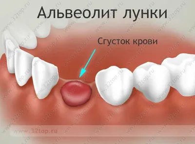 Альвеолит лунки: причины, симптомы, лечение