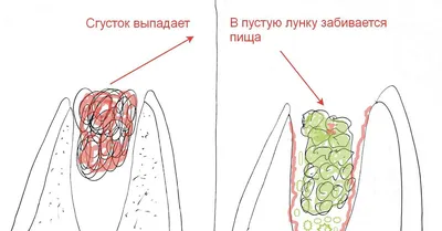 Сага о стоматологии. Глава 24. Что делать если сильно болит челюсть после  удаления зуба? Как лечить альвеолит лунки? | Пикабу