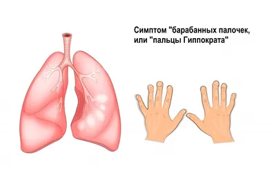 Фиброзирующий альвеолит - причины появления, симптомы заболевания,  диагностика и способы лечения