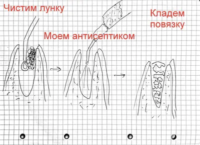 Альвеолит лунки зуба: симптомы и лечение ▶️Eurodent.kz