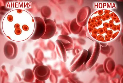 Анемия у пожилых людей, причины, лечение, питание при недостатке железа