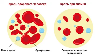 Анемия, симптомы и лечение, виды и диагностика