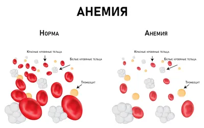 Анемия – симптомы, лечение, диагностика