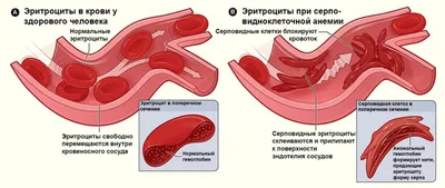 Симптомы и лечение анемии - терапевт рассказал о болезни | РБК Украина