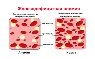 Анемия (малокровие): симптомы, лечение, степени, виды