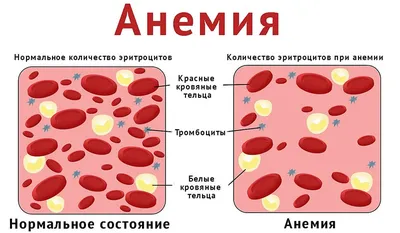 Железодефицитная анемия у больных с заболеваниями хирургического профиля –  тема научной статьи по клинической медицине читайте бесплатно текст  научно-исследовательской работы в электронной библиотеке КиберЛенинка