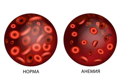 Анемия: что это, симптомы, виды, степени, лечение и профилактика