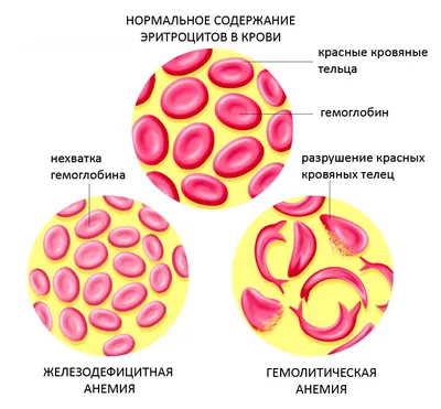 Железодефицитная анемия: причины, симптомы, лечение - Пантопроект