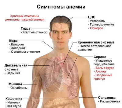 Железодефицитная анемия: симптомы и причины