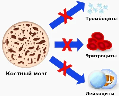 Железодефицитная анемия - симптомы, диагностика, лечение, клинические  рекомендации и препараты