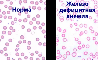 Анемия у пожилых людей, причины, лечение, питание при недостатке железа