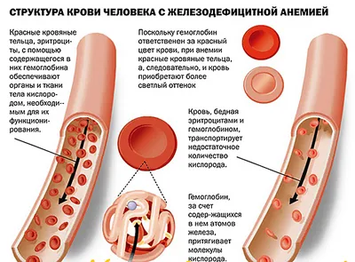 Анемия: какие они бывают, причины и симптомы наиболее распространенных  анемий