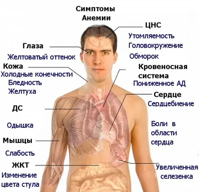 Анемия: симптомы, признаки малокровия, причины, степени тяжести и лечение