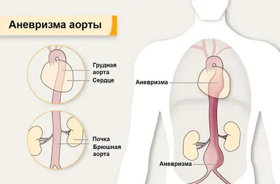 Ложная аневризма маточной артерии - Национальный центр хирургии