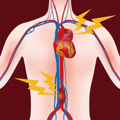 Вы знаете что такое аневризма сердца? Рассказываем о грозном осложнении  инфаркта и не только | О здоровье: с медицинского на русский | Дзен