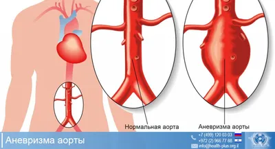 Медицина та Мишко - Аневризма аорты Аневризма — баллоноподобная выпуклость  или вздутие в артерии. Аневризма аорты — это аневризмы, которые возникают в  аорте, основной артерии, по которой переносится кровь богатая кислородом по
