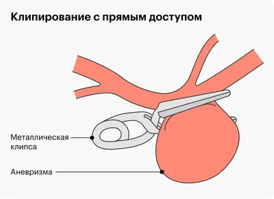 Расслаивающая аневризма аорты