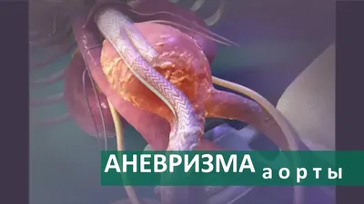 Истинные аневризмы висцеральных артерий: лучевые методы диагностики и  лечения - Журнал Доктор Ру
