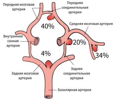 Аневризма аорты: лечение в Киеве | Akhmad Vascular