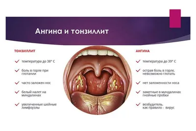 AnnaMama - Про ангину Воспаление небных миндалин и слизистой глотки:  тонзиллит (ангина), фарингит-основная причина боли в горле. Возбудители  ангины-бактерии, вирусы, грибы и др. 1️. Наиболее частые  возбудители-вирусы: антибиотики не нужны проходит ...