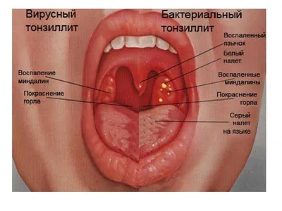 Ангина | 1ДМЦ