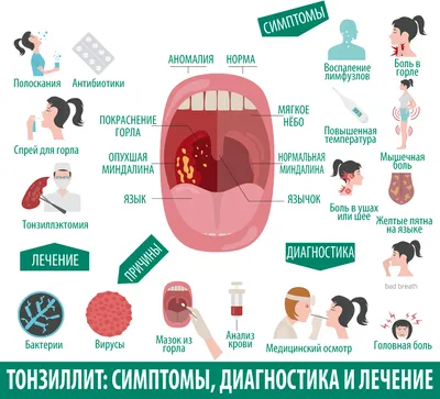 Ангина у взрослых: лечение, симптомы, отличия