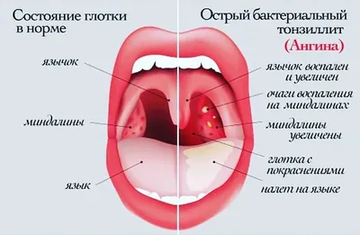 Фолликулярная ангина, лечение и симптомы, заразна ли фолликулярная ангина,  как передается - блог Furasol®