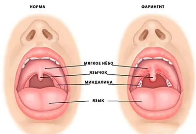 Ангина у детей | Энциклопедия горла ГЕКСОРАЛ®