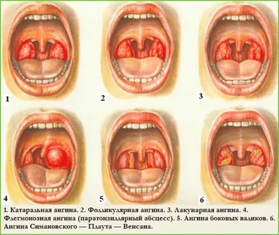 Гнойная ангина