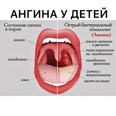 Стрептококковая ангина лечение, симптомы, инкубационный период, стрептококк  ангина — блог Furasol®