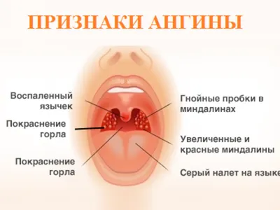 Ангина: причины, симптомы, лечение - МедКом